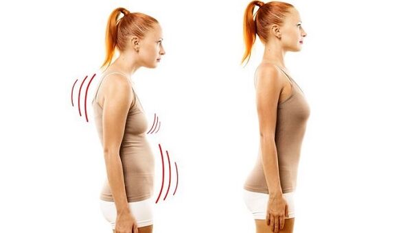 ευθεία πλάτη και κακή στάση με αυχενική οστεοχόνδρωση